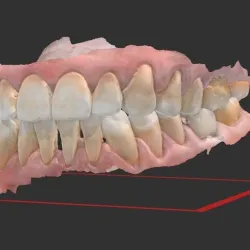 colored dental models with periodontitis