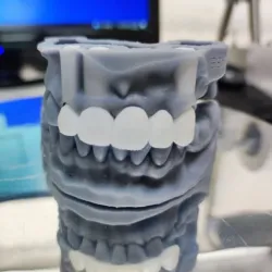 dental model with removable and bridge/ Dental model with removable and bridge/