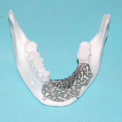Individual mesh membrane for bone reconstruction of the jaw (examples of real operations)