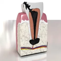 Decayed Tooth 3D model