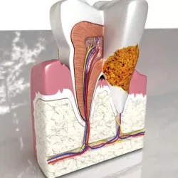 Tooth Dental Plaque High Detail 3D model