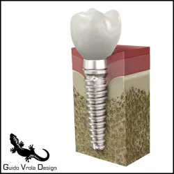 Dental Implant 3D model