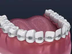 Dental orthodontic braces 3D model