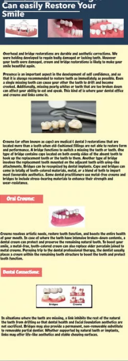 Pottery crowns Cambridge Ontario Canada Dentist in Ontario