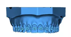 Human Teeth with Braces 3D print model