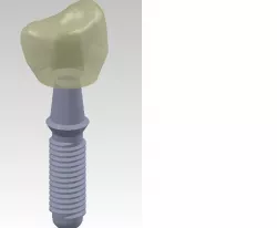 dental prosthesis Free 3D model