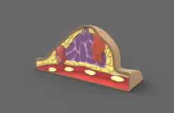 Breast With Cancer - printable 3D model
