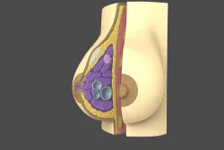 Breast with cyst - printable 3D model