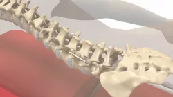 Human Spine and Implant 3D model