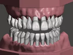 Maxillary and Mandibular dental models 3D print model