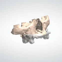 BIOMODEL + SURGICAL GUIDE