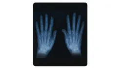 Hand Xray