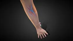 3D Injected Cannula with sticking plaster