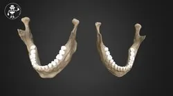 Male vs Female Mandible