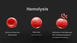 Hemolysis