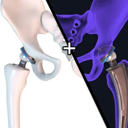Hip replacement implant installed in the pelvis bone