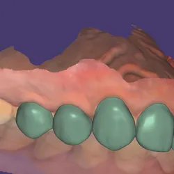 3d printed veneers  (no prep)