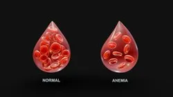 Normal Blood Cells vs Anemia