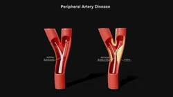Peripheral Artery Disease
