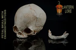 Fetal Skull with Craniosynostosis (Pre Supported)
