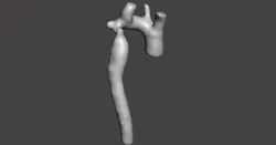 Coarctation of the Aorta