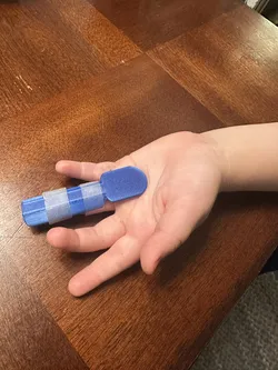 Range Limiting Finger Splint