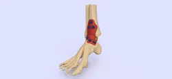 Ankle implant