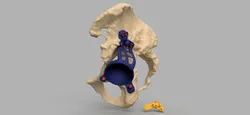 Hip cavity implant