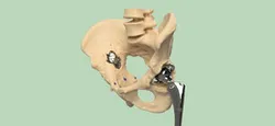 Hip cavity implant