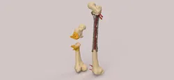 Individual femoral implant on the type of truss