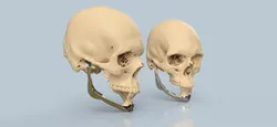 Jaw's patient specific implant