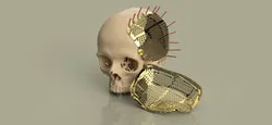 Patient-specific cranial implant