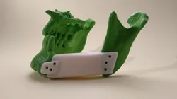 Patient-Specific Implants