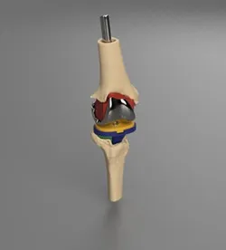 Total knee replacement project