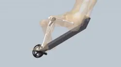 Knee Tumor Prosthesis