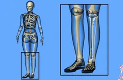 Tibial Intramedullary Nail