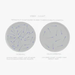 Sperm Count - Normal vs Oligospermia