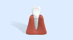 Evolution de la parodontite / periodontitis
