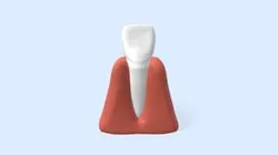 Évolution de la gingivite / Gingivitis