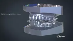 Digital Telescopic Herbst Appliance 3D print model