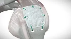 Pitch-Patch Open Technique