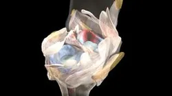 Medial meniscus radial tear