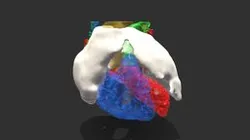 Complex Tumor