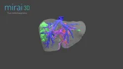 Tumor hepático - Dr. Gustavo Nari