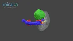 Tumor renal - Dr. Francisco Telayna Manrique