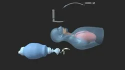 Adult Intubation - Procedure Demonstration