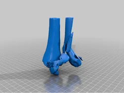 Broken ankle