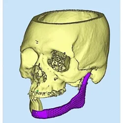 MANDIBLE IMPLANT DESIGN