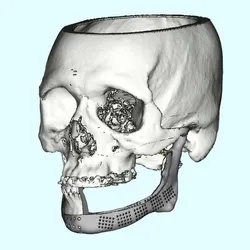 MANDIBLE IMPLANT