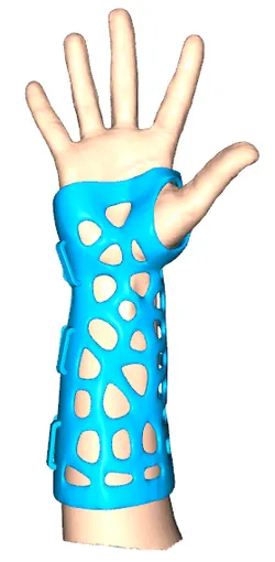 Patient Custom Hand, Wrist & Thumb Brace / Orthosis / Splint
